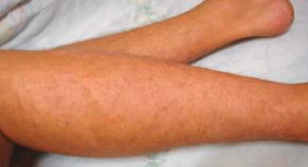 Результат лечения псориаза:после курса СКЭНАР-терапии  кожа чистая